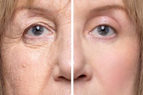 Resultado de blefaroplastia